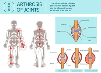 Arthrosis of Joints. Vector Illustration.