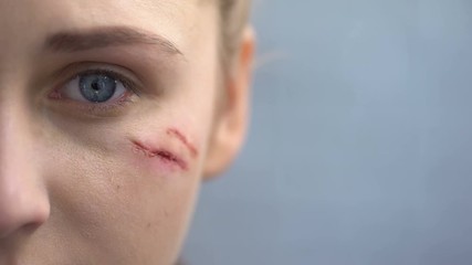 Wall Mural - Defenseless female with scars on her face looking into camera, domestic violence