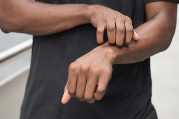 man suffering from itching skin; sick african man scratching his skin with allergy, rash, ringworm, tinea problem; health care, skin care, dermatology concept; adult african man, black man model.