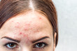 © anastas_ - portrait of a young woman with pimples, pigmentation spots and post acne