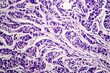 Lymph node cancer, light micrograph, photo under microscope