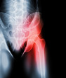 © yodiyim - Hip painful skeleton x-ray, 3D illustration.