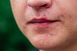 © yurakrasil - pimples on the face of a man close-ups