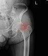 © Richman Photo - X-ray left hip : fracture left Neck of femur ( Thigh bone ).