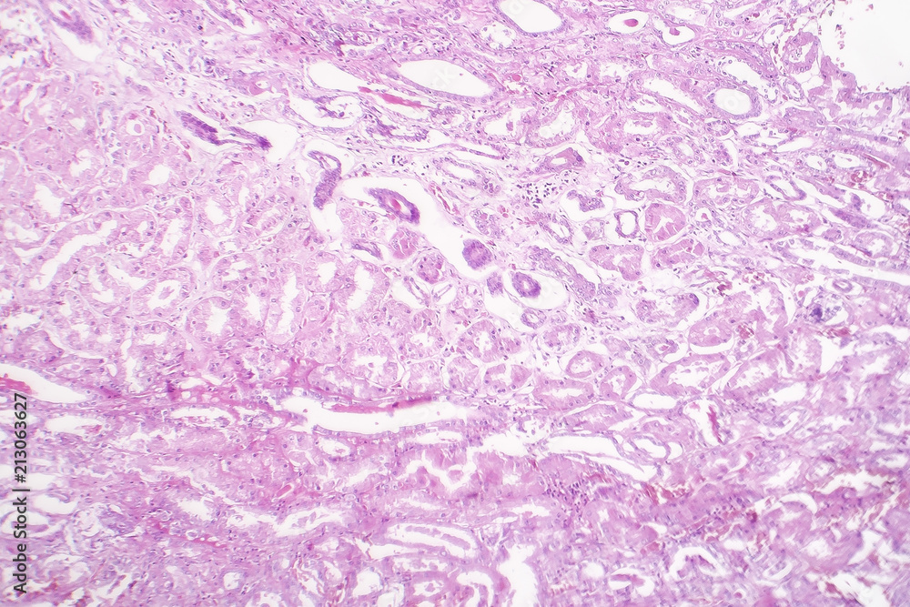 Tubular epithelial edema, light micrograph, photo under microscope ...