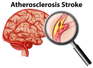 Canvas Print - Atherosclerosis Stroke on White Background