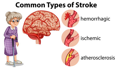 Wall Mural - common types of stroke