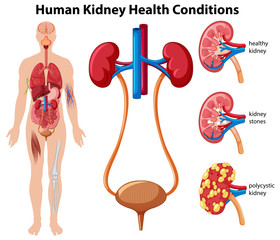 Canvas Print - Human Kidney Health Conditions