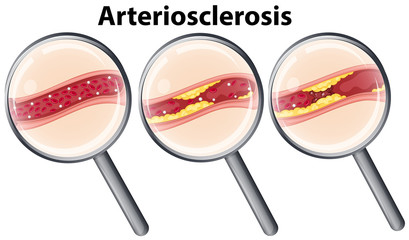 Canvas Print - Human with Arteriosclerosis magnified