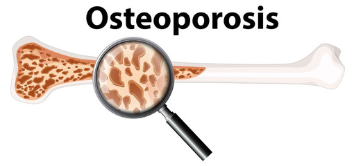 Canvas Print - Osteoporosis and Magnifying Glass