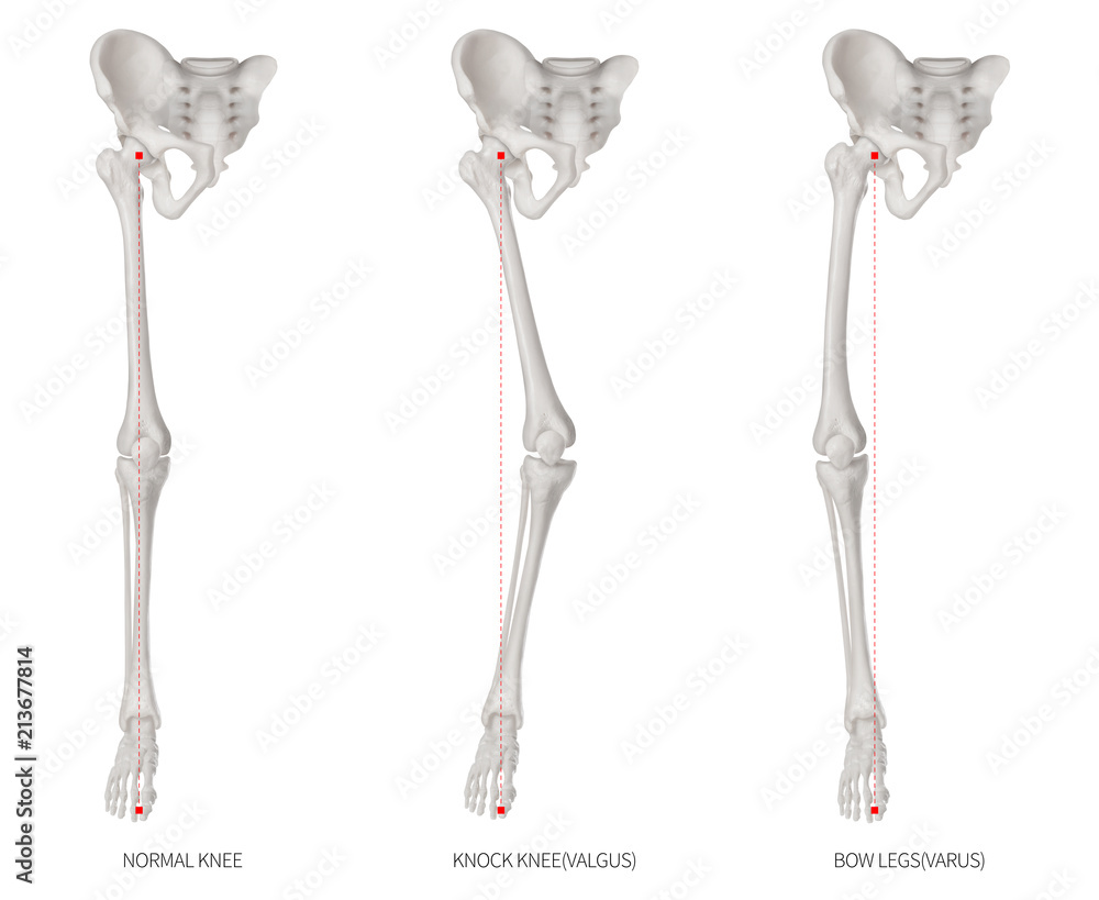 Alignment types disease of lower half limbs or leg bone problem- Normal ...