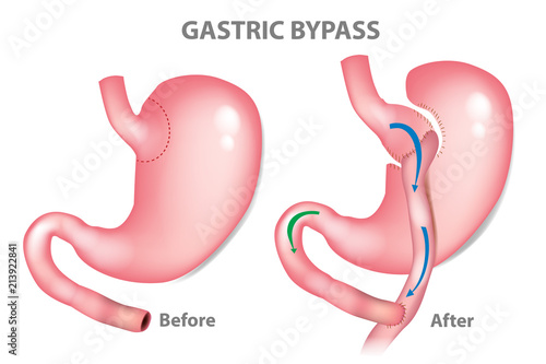 Cuadros en Lienzo Gastric bypass surgery - RNY (Roux-en-Y ). MINI-GASTRIC BYPASS