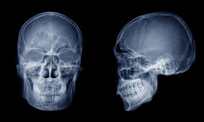 very good quality x-ray image of normal human skull front (ap) view and side (lateral) view, process