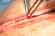 Patient wound suturing process as a part of a surgical treatment