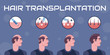 Hair transplantation steps
