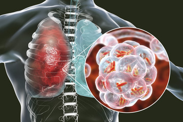 Canvas Print - Bacterial pneumonia, medical concept. 3D illustration showing rod-shaped bacteria inside alveoli of the lung