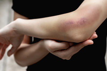 A Teenager Girl Show A Big Purple Bruise On Her Left Arm That Is Caused By Her Accidentally Fall Off From The Stairs.