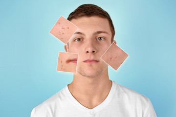 Young man with acne problem on color background