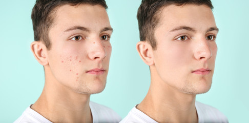 Young man with acne problem on color background
