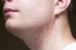 © Pavlo - Irritation after shaving on the neck of a man, close-up