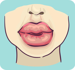 Sticker - Symptoms Swelling Lips Illustration