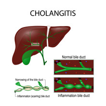 Cholangitis. Cross Section Of The Human Liver, Bile Duct, And Gallbladder.