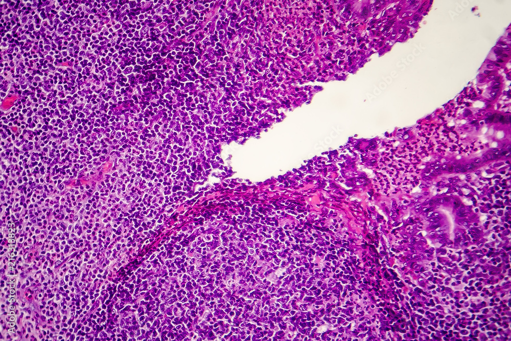 Suppurative appendicitis, light micrograph, photo under microscope ...