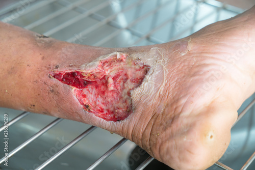 Close up Infected wound.Opened wound at left leg Poster Mural XXL