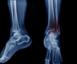 x-ray image tibia fracture
