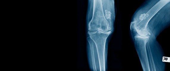 Wall Mural - x-ray OA knee with structure like calcium