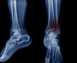 Poster - x-ray image tibia fracture