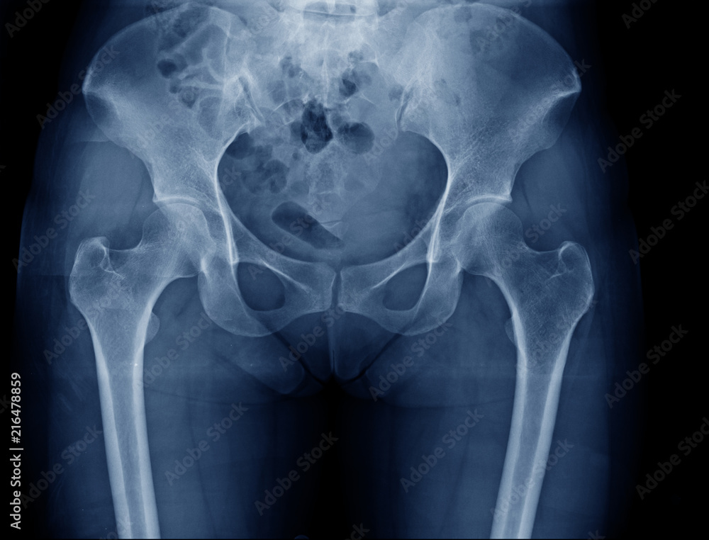 hip and pelvic bone x-ray - obrazy, fototapety, plakaty 
