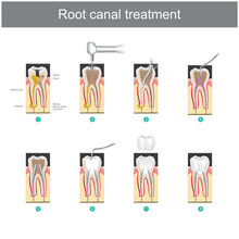 Root Canal Treatment. How To Treat Our Teeth After The Tooth Is Damaged. Or Severe Caries As Causes Infection Or Inflammation