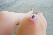 wound scabs on knee of human.