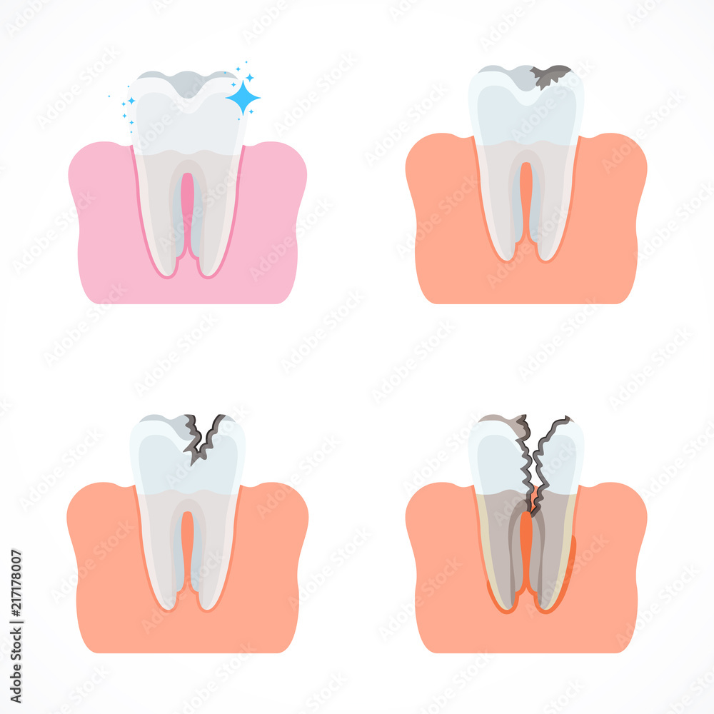 Stages of tooth decay with caries. Dentistry and oral care. Flat vector ...