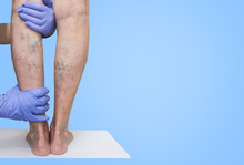 Lower Limb Vascular Examination Because Suspect Of Venous Insufficiency. The Female Legs On Blue Background. Varicose Veins Concept