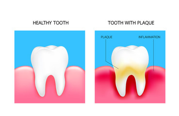 Dental plaque with inflammation and healthy tooth. Illustration isolated on blue background. Dental care concept.