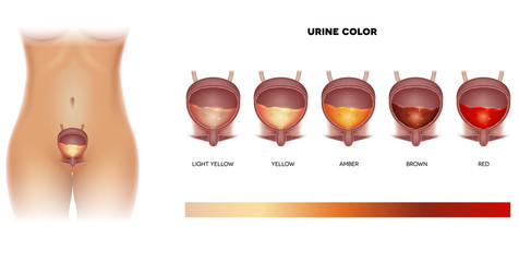 Wall Mural - Urine color chart from light yellow till red color. Urinary bladder detailed anatomy and urine inside