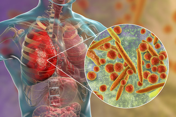 Poster - Lung infection caused by bacteria Mycoplasma pneumoniae, 3D illustration. Bacterial pneumonia medical concept