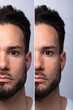 © Andrey Popov - Man's Face Before And After Cosmetic Procedure