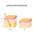 liposuction procedure. Before and after.