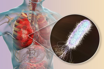 Poster - Lung infection caused by bacteria Pseudomonas aeruginosa, 3D illustration. Nosocomial pneumonia. Pneumonia in immunocompromised patients, in persons with cystic fibrosis, mucoviscidosis