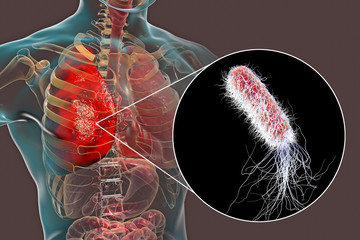 Wall Mural - Lung infection caused by bacteria Pseudomonas aeruginosa