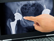 doctor's hand pointing xray photos of total hip replacement in medical application on black laptop computer