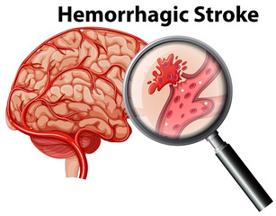 Canvas Print - A human anatomy hemorrhagic stroke