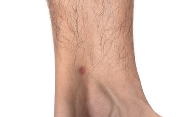 red dot on skin from bite bugs