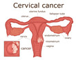© scio21 - Illustration of cervical cancer