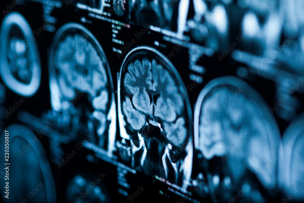The X-ray of the human brain - obrazy, fototapety, plakaty 