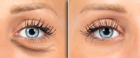 Woman red eye before and after eye bags removal