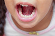 Kid with crooked teeth